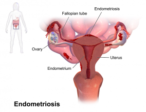 Blausen_0349_Endometriosis