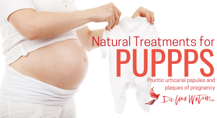 Natural Treatments for PUPPPS